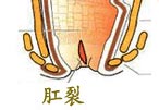 大便肛门疼痛怎么回