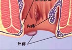 混合痔要趁早治疗