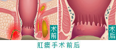 HCPT微创术——高位肛瘘的