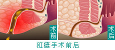 HCPT微创术——高位肛瘘的