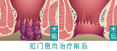 微创技术根治直肠息肉