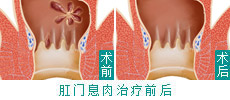 微创技术根治直肠息肉