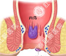 痔疮的最佳治疗方法 