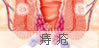 痔疮