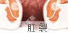 肛裂