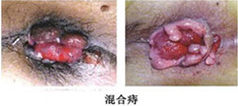 痔疮-混合痔