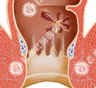 慎防肛门息肉误诊