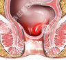 科学检查痔疮疾病
