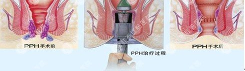 PPH手术过程