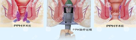 医博智能肛泰方法PPH