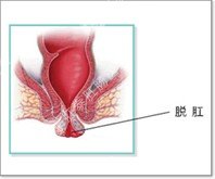 脱肛示意图