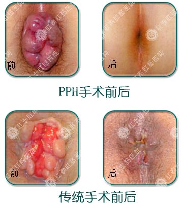 传统手术与医博PPH手术前后对比