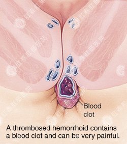 如何避免痔疮术后出现后遗症