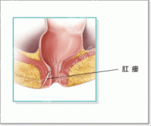 男性肛瘘早期症状是什么