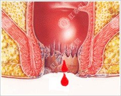 肛门便血