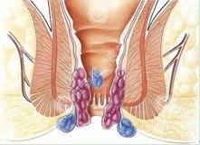 进食过饱患痔疮不治能好吗?