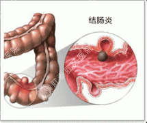 慢性结肠炎的原因有哪些？