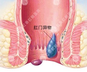 福州肛肠医院