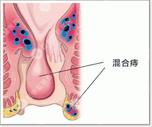 得了痔疮怎么办？