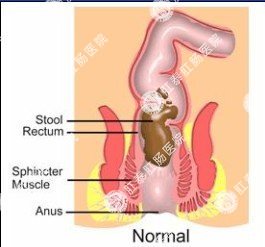 福州肛肠医院