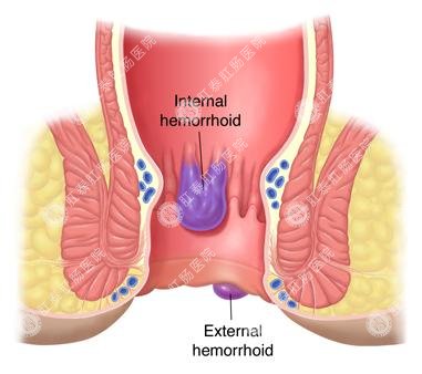 福州肛肠医院