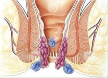 具备哪些症状才能诊断为痔疮