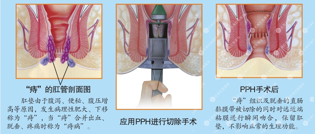 福州肛肠医院