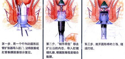 福州肛肠医院