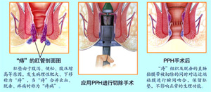 福州肛肠医院