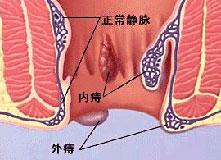 福州肛肠医院