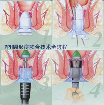 福州肛肠医院