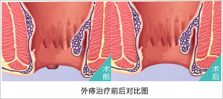 福州肛肠医院 福州医博肛肠医院 福州看痔疮的医院 福州肛瘘医院 福州肛裂医院 福州肠炎医院