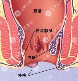 福州肛肠医院