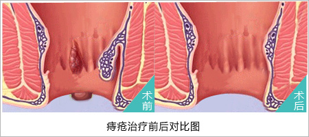 福州肛肠医院 福州医博肛肠医院 福州看痔疮的医院 福州肛瘘医院 福州肛裂医院 福州肠炎医院