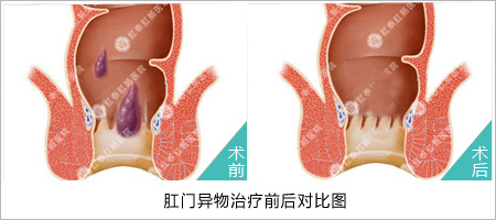 福州肛肠医院