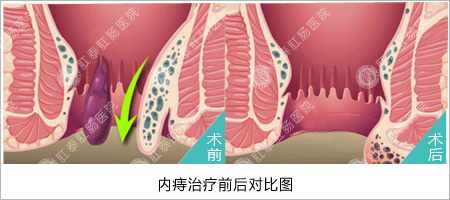 福州肛肠医院