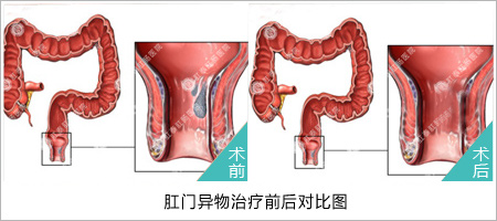 福州肛肠医院