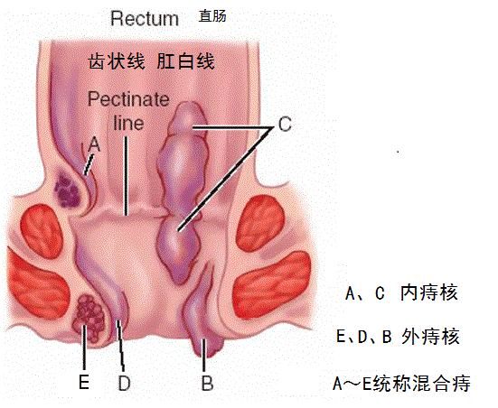 痔疮科普图解