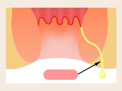 肛瘘科普图片