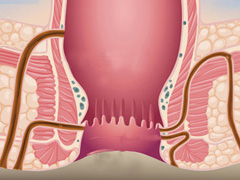 肛漏科普图解