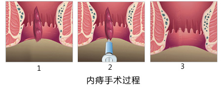 痔疮手术过程科普图片