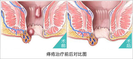 痔疮治疗前后对比图