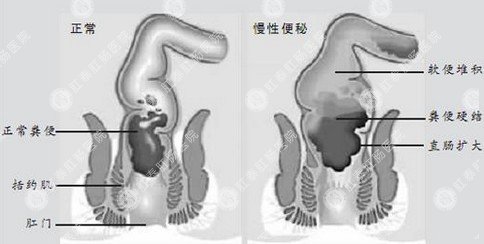 直肠肛管肛狭窄