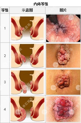 内痔分期 - 痔疮分度