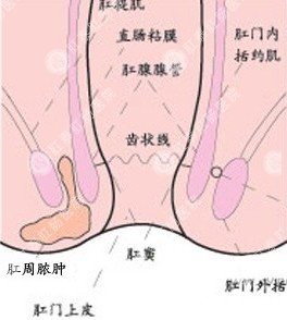 肛周脓肿科普图片