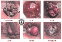 内痔、外痔、混合痔图片