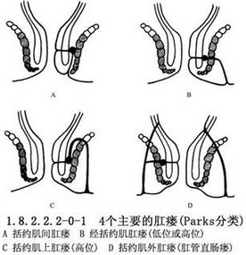 高低位肛瘘示意图