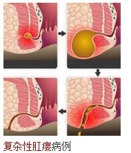 复杂性肛瘘的临床症状图片