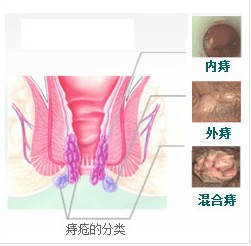 福州市医院治疗痔