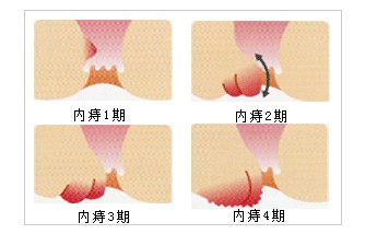 内痔的危害都有哪些？